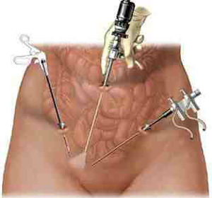 laparoscopic-appendectomy