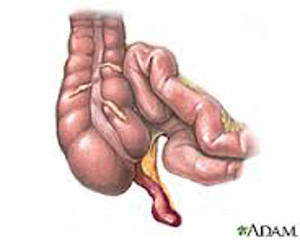 appendicitis-anatomy