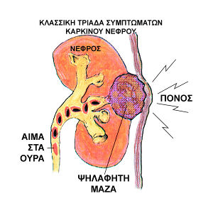 συμπτώματα καρκίνου νεφρού
