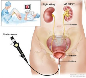 ureteroscopy