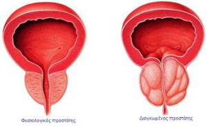 prostate-hyperplasy